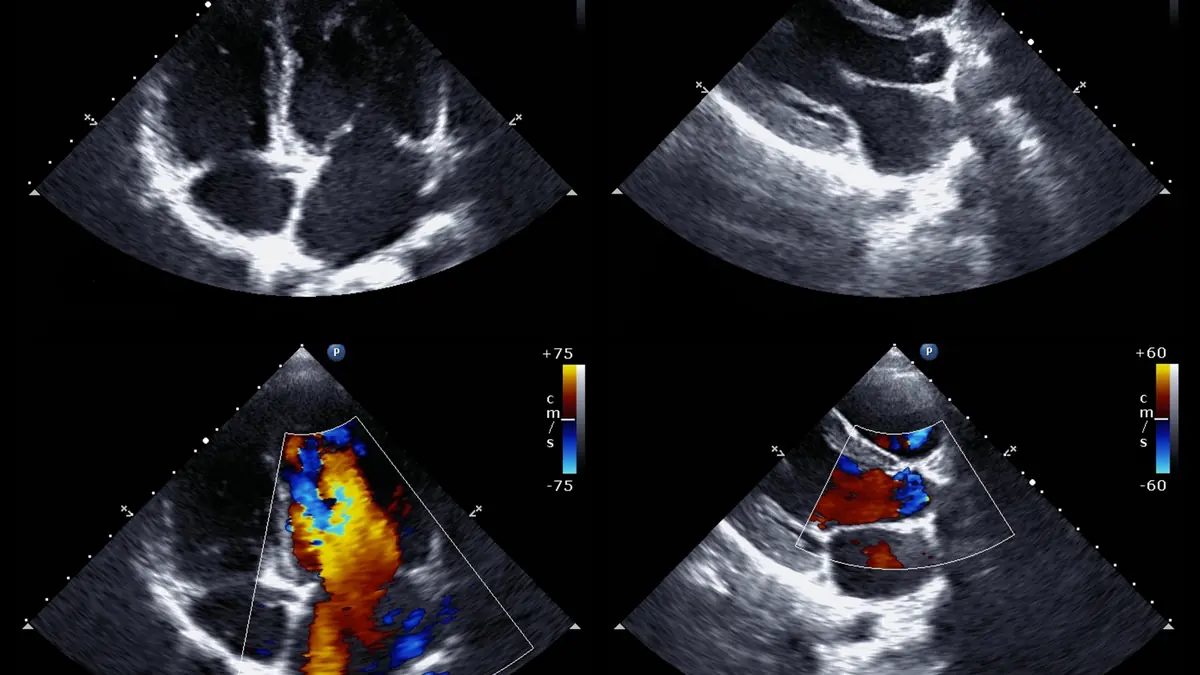 Echocardiogram of the heart