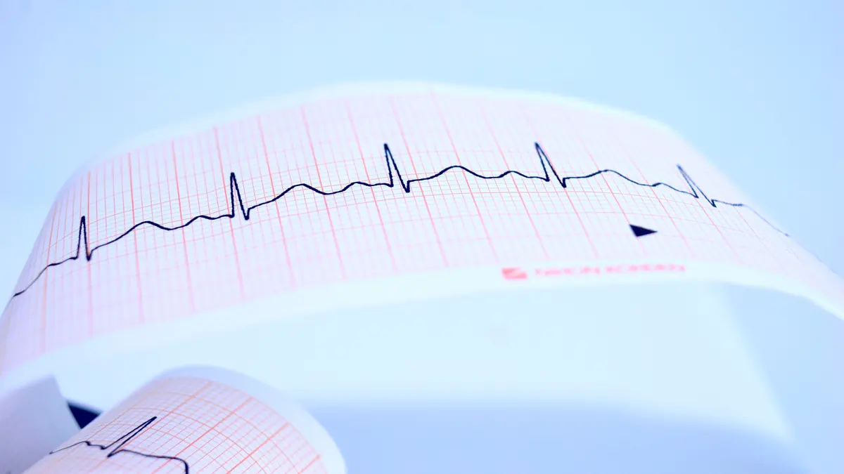 EKG rhythm tracing