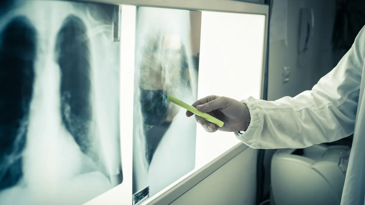 Chest X-ray image